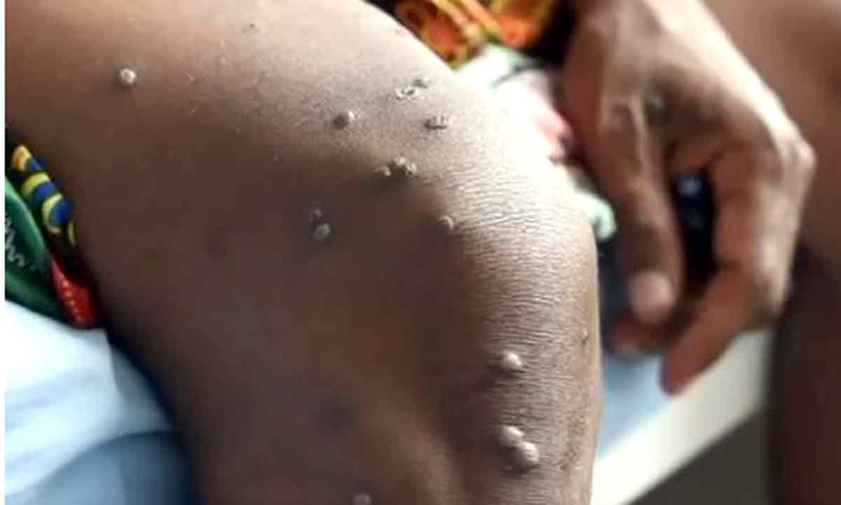 MPOX : Un treizième décès survenu le 25 juin 2026